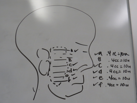 60 units of onabotulinum toxin (Botox - type A) intradermal injection