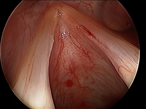 Intraop Microdirect Laryngoscopy with Resection