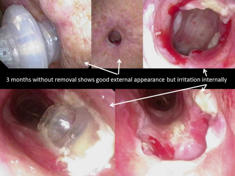 Irritation from cannula causing inflamation and tissue reaction