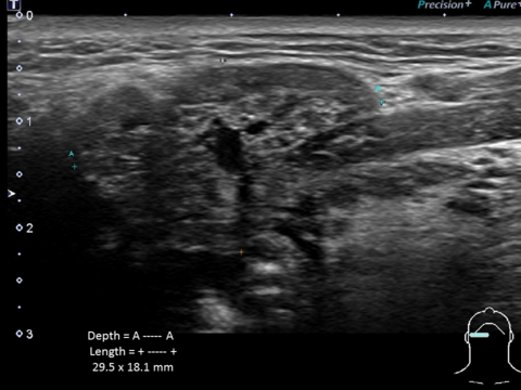 Transverse ultrasound of submandibular region showing 29.5 x 18.1 mm gland