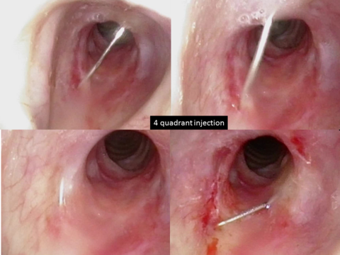 Injection of 4 quadrants with positioning of the needle