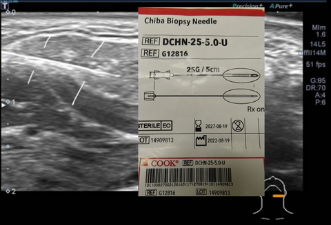 echogenic needle for botox infusion