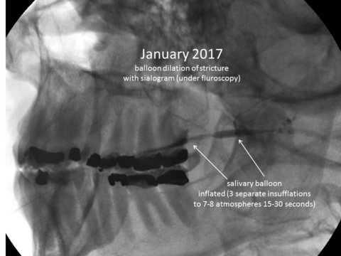 January 2017 salivary balloon inflated at site of stricture