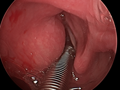 Intraop