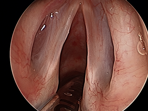 Intraop Microdirect Laryngoscopy with Resection