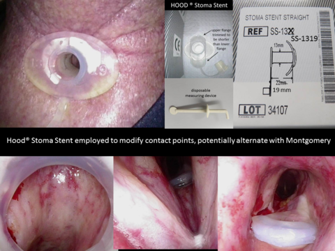 Hood stoma stent placed to modify pressure points on trachea