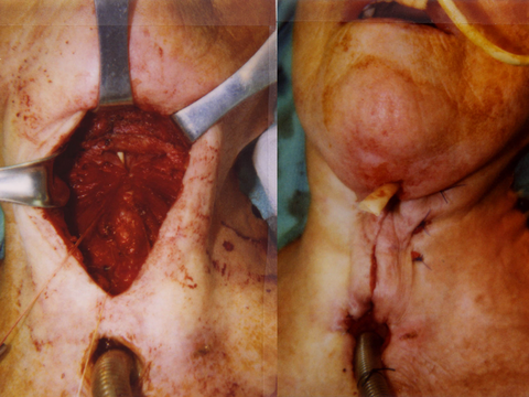 Near-Field Laryngectomy Sequence