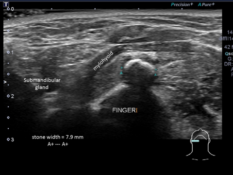 "Sono-palpation" with index finger in the mouth palpating stone 