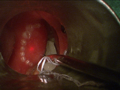 Intraop