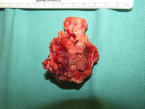 Near-Field Laryngectomy Sequence