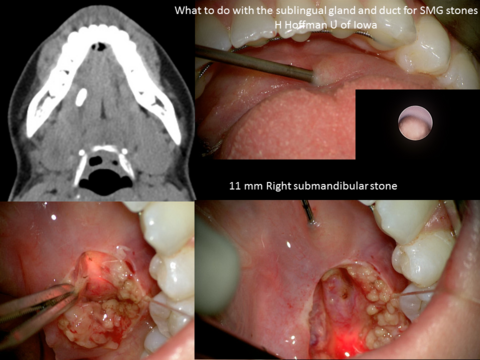 Sialendoscopy assisted transoral approach to duct and stone
