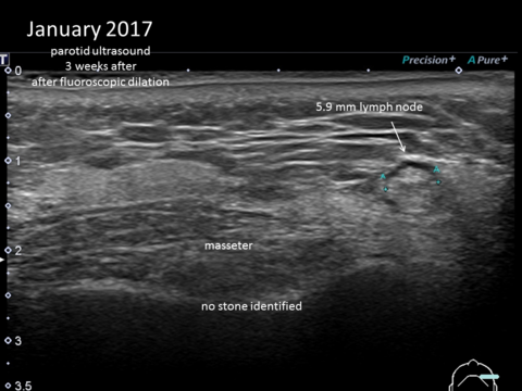January 2017 Ultrasound done three weeks after fluoroscopy for repeat dilation in clinic