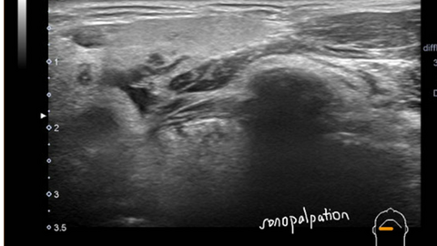 ultrasound and sialogram correlates of submandibular duct obstruction