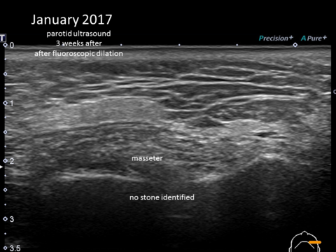 January 2017 ultrasound in clinic shows no discernible stone