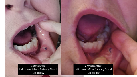 lip biopsy 9