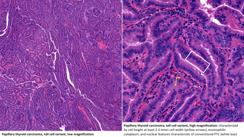 Papillary thyroid carcinoma, tall cell variant, low magnification (left) and high magnification (right). Papillary thyroid carcinoma, tall cell variant, low magnification (left) and high magnification (right).