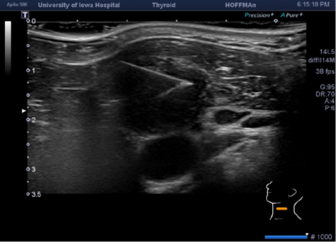 US 25G FNA Left Level III Node (Longitudinal)