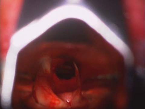  after biopsy (acute inflamation and fibrosis) and dilation with rigid Jackson laryngeal dilator