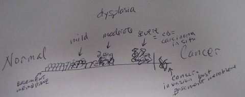 diagram%20of%20dysplasia.jpg
