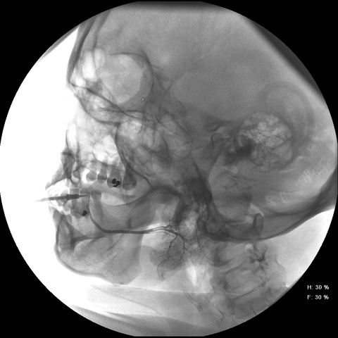 Contrast infused into normal ductal system