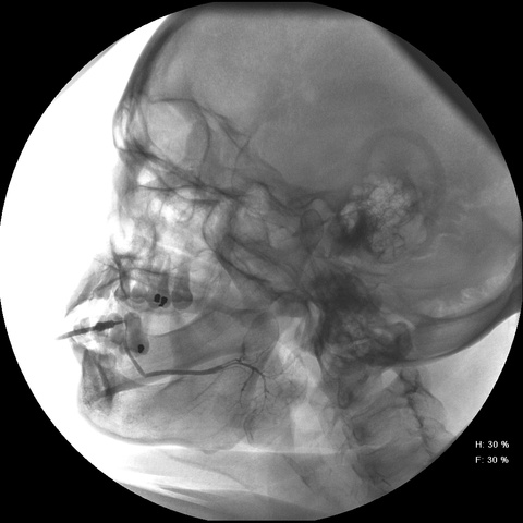 Lateral view- note angulation of duct around mylohyoid