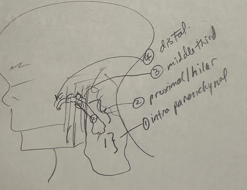 parotid diagram 09272024.png parotid diagram 09272024.png