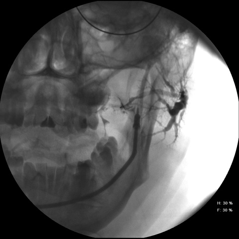 lateral view shows stone in duct with marked dilation of ductal system