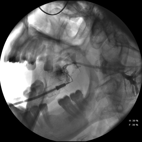 Catheter in place before contrast