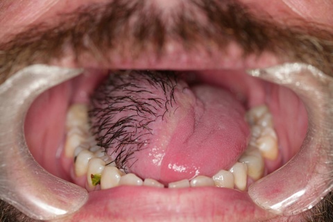 Submental flap 3 months post-operatively,