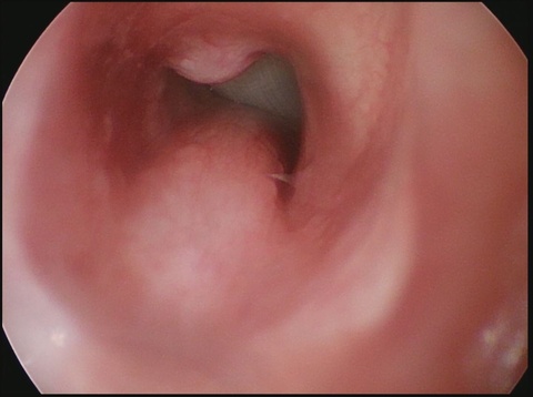 Suprastomal granulation tissue with tracheostomy tube still in place