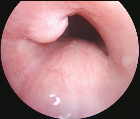 Suprastomal granulation tissue with tracheostomy tube removed