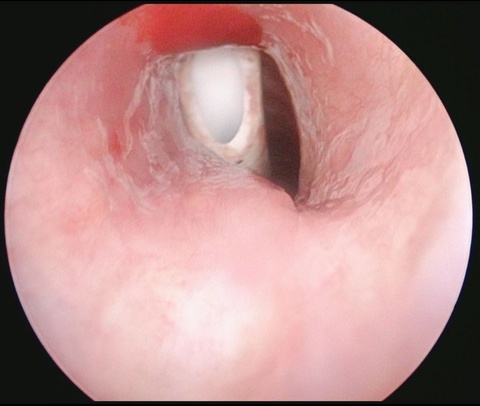 Fenestrated tracheostomy tube in airway