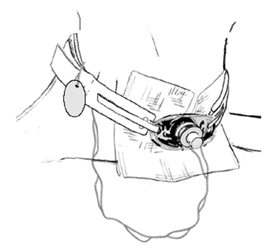 tracheostomy4_0.gif