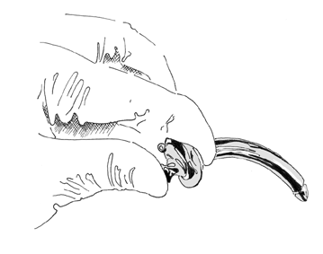 tracheostomy7_0.gif
