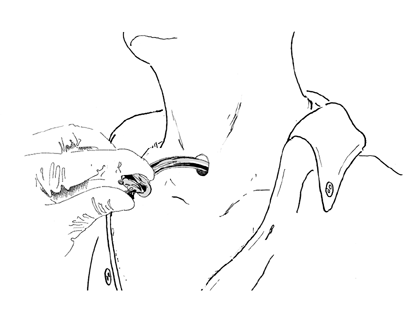 tracheostomy8_0.gif