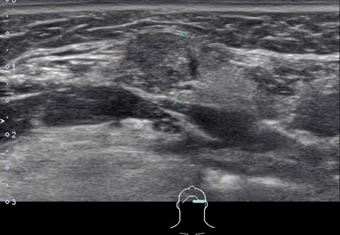 Preoperative ultrasound: 