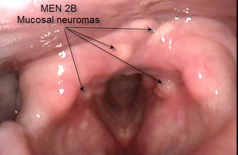 020%20laryngeal%20mucosal%20neuromas.jpg 020%20laryngeal%20mucosal%20neuromas