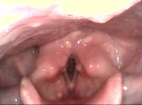 021%20laryngeal%20mucosal%20neuromas.jpg 021%20laryngeal%20mucosal%20neuromas