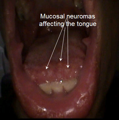 022%20tongue%20mucosal%20neuromas.jpg 022%20tongue%20mucosal%20neuromas