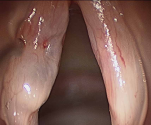 024 sulcus