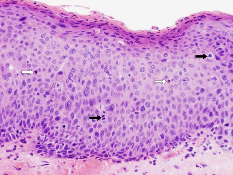 030%20cis%20dyskeratosis