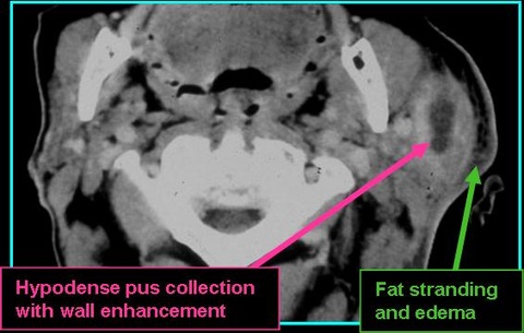 Abscess_CT_0721.jpg Abscess_CT_0721