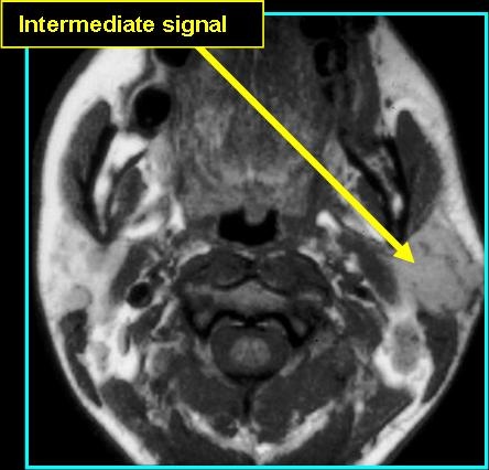 Abscess_T1_0721.jpg Abscess_T1_0721