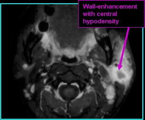 Abscess_T1post_0721.jpg Abscess_T1post_0721