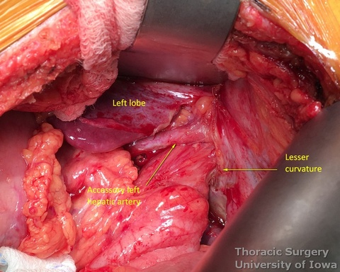 ccessory left hepatic artery originating from the left gastric artery