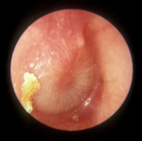 Acute_Otitis_Media_Stage_of_Resolution