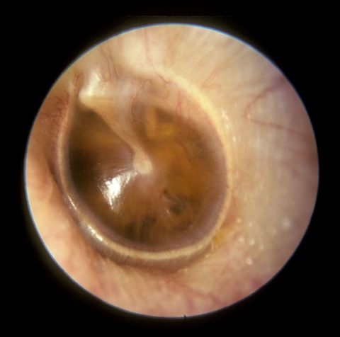 Adult_Serous_Otitis_Media