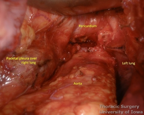  illuminated transhiatal retractor  facilitates hemostasis check in the mediastinum after esophagectomy