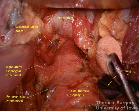 Posterior mediastinum exposed
