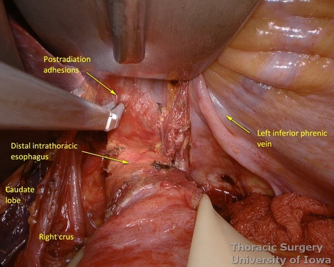 Arshava illuminated transhiatal retractor allows division of periesophageal attachments and postradiation adhesions under direct vision